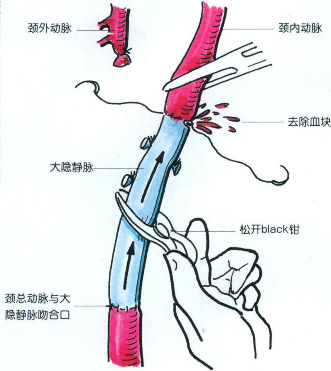 手術(shù)解剖要點(diǎn)